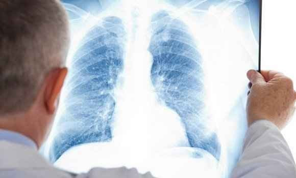 Journée de sensibilisation sur la Fibrose pulmonaire idiopathique